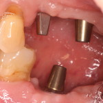Dental Implants Unrestored