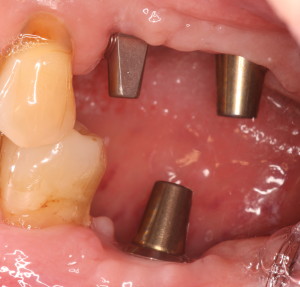 Dental Implants Unrestored