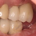 Dental Implant Restorations