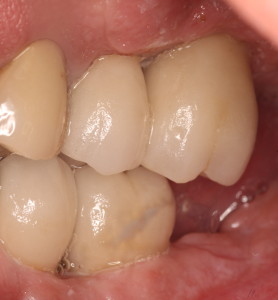 Dental Implant Restorations