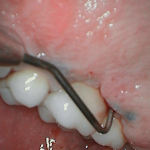 Bone Loss-Dental Implants