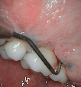 Bone Loss-Dental Implants