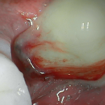 Inflammation present after dental implants removed