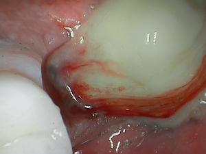 Inflammation present after dental implants removed