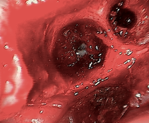 Sinus perforation due to dental implants