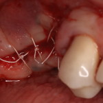 Closure of surgical site after dental implants removed