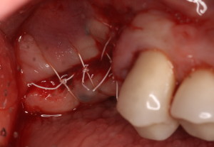 Closure of surgical site after dental implants removed