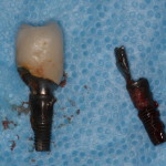 Infected dental implants after removal.