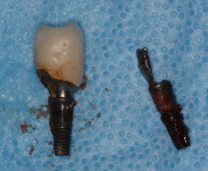 Infected dental implants after removal.