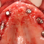 Dental Implants without Surgical Guide