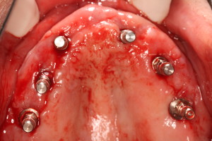 Dental Implants without Surgical Guide
