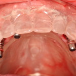 Dental Implants Surgically Placed with Guide