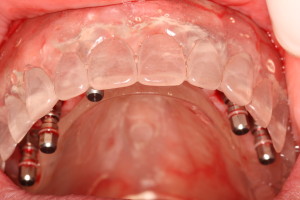 Dental Implants Surgically Placed with Guide
