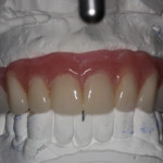 Mounted Denture to Dental Implants