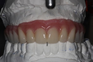 Mounted Denture to Dental Implants