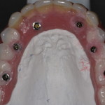 Fitting Denture to Dental Implants