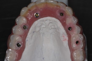 Fitting Denture to Dental Implants