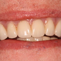 Dental Implants Supporting Upper Denture