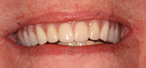 Dental Implants Supporting Upper Denture