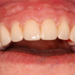 Dental Implants & Denture Front View