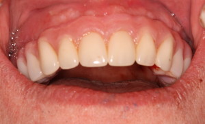 Dental Implants & Denture Front View