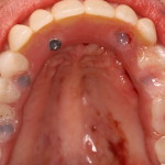 Dental Implants & Denture Occlusal View