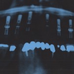 Pano X-Ray of Dental Implants