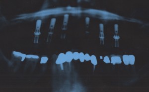Pano X-Ray of Dental Implants