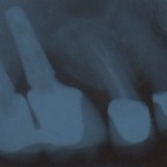 Infection & Dental Implants