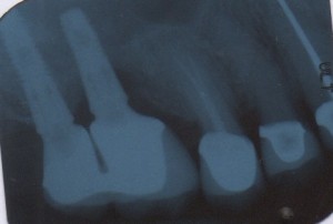 Infection & Dental Implants