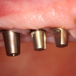 Dental Partial replaced with Dental Implants-OKC