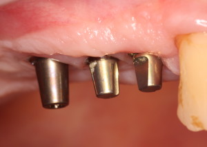 Dental Partial replaced with Dental Implants-OKC