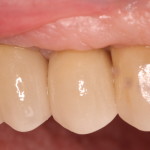 Dental Implants eliminate need for patient's removable appliance