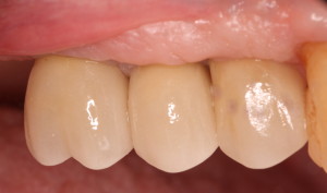 Dental Implants eliminate need for patient's removable appliance