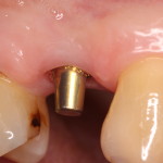 Minimally Invasive Dental Implant