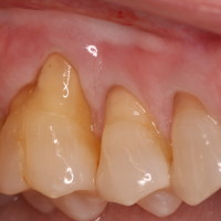 Gingival Recession