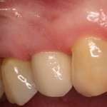 Restored Minimally Invasive Dental Implant