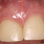 Anterior Dental Implants & Gum Surgery