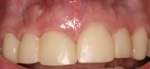 Anterior Dental Implants & Gum Surgery