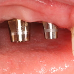 Dental Implants with Abutments