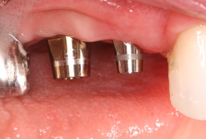 Dental Implants with Abutments