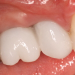 Dental Implants with Crowns