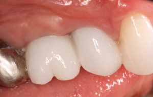 Dental Implants with Crowns