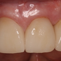 Final Pic: Dental Implants & Teeth