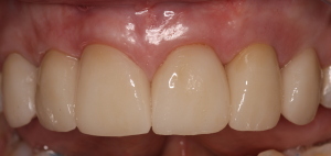 Final Pic: Dental Implants & Teeth