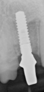 X-Ray Single Dental Implant