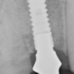 X-Ray Single Dental Implant