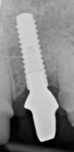 X-Ray Single Dental Implant