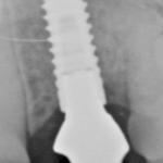 X-Ray Single Dental Implant
