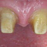 Unrestored Anterior Dental Implants